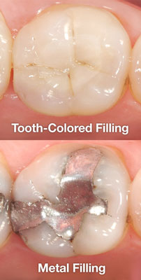 Dental Filling El Paso, TX - Edgemere Dental
