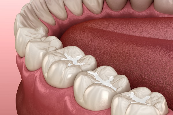 Dental Sealants - Edgemere Dental